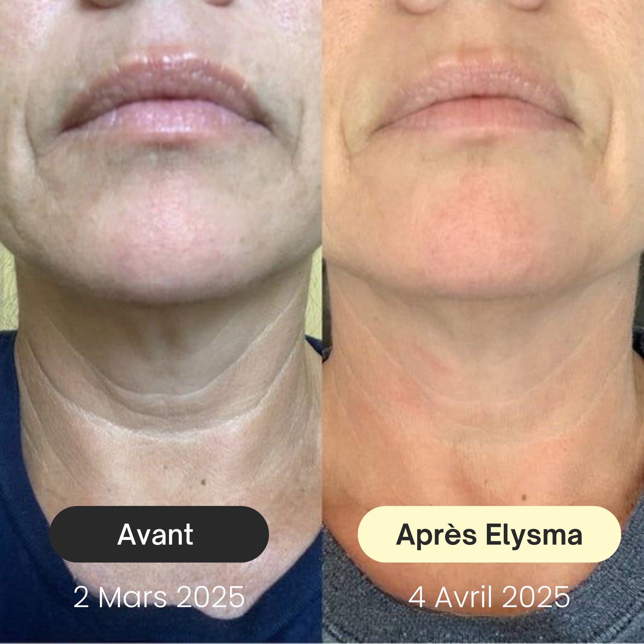 Crème Lifting Ciblé – Cou & Contours