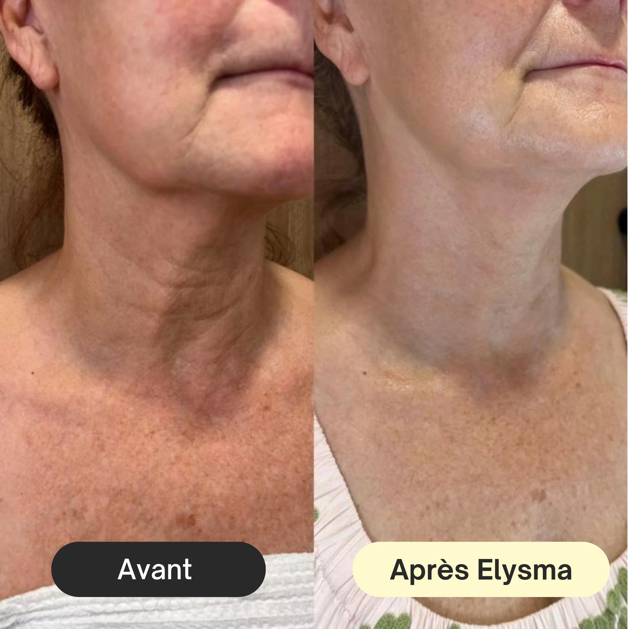 Crème Lifting Ciblé – Cou & Contours